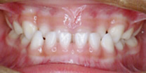 乳歯の反対咬合(受け口)の治療前の症例写真