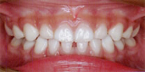 乳歯の反対咬合(受け口)の治療後の症例写真