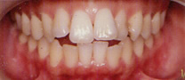 永久歯列の矯正治療前の症例写真1