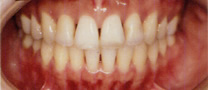 永久歯列の矯正治療後の症例写真1