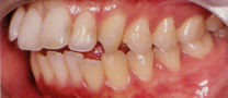 永久歯列の矯正治療前の症例写真2
