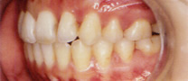 永久歯列の矯正治療後の症例写真2