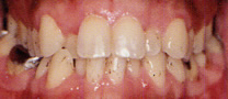 永久歯列の矯正治療前の症例写真3
