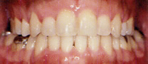 永久歯列の矯正治療後の症例写真3