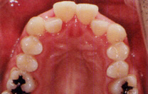 永久歯列の矯正治療前の症例写真4