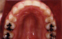 永久歯列の矯正治療後の症例写真4