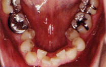 永久歯列の矯正治療前の症例写真5