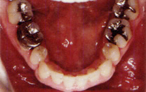 永久歯列の矯正治療後の症例写真5